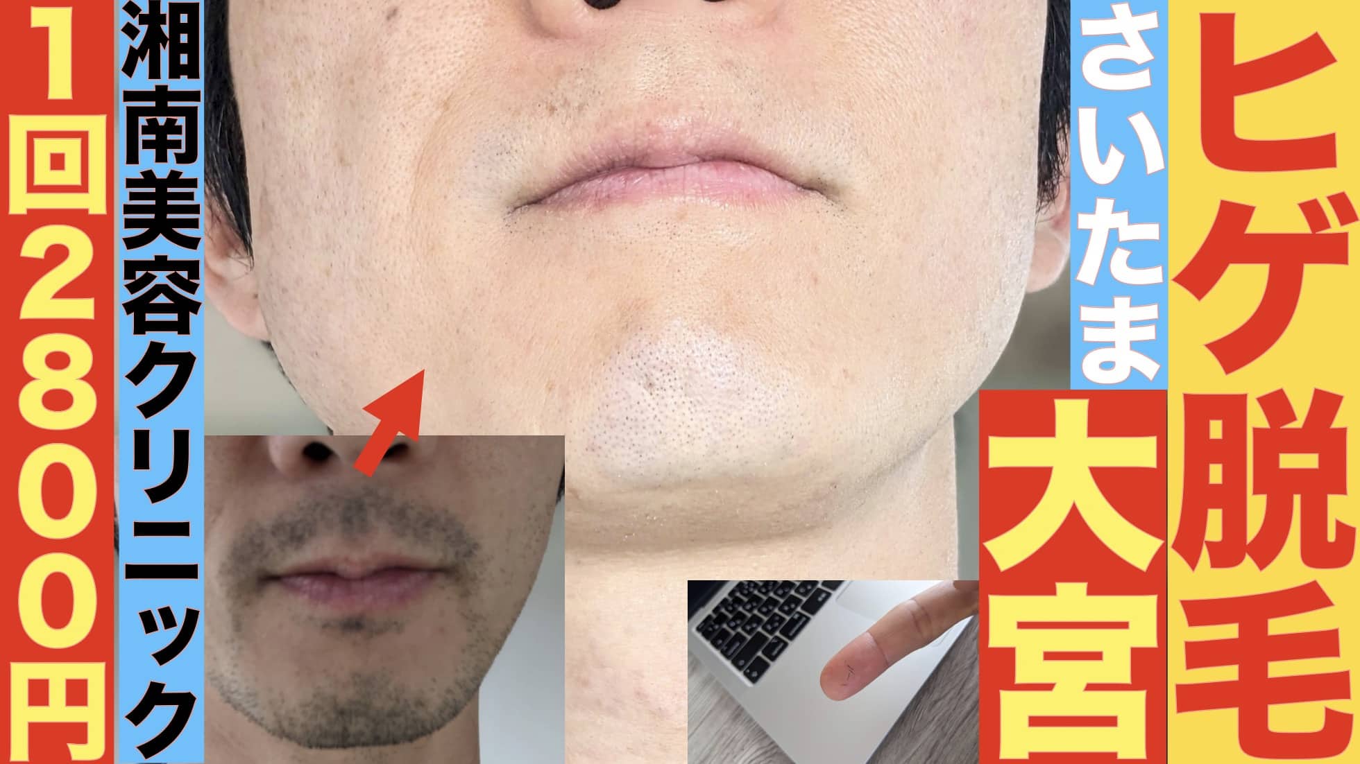 1回2800円で医療ヤグレーザー！大宮でヒゲ脱毛なら湘南美容クリニックがおすすめな３つの理由サムネイル画像