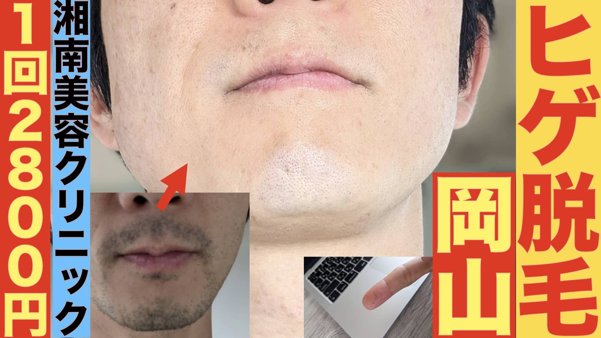 1回2800円で医療ヤグレーザー！岡山でヒゲ脱毛なら湘南美容クリニックがおすすめな３つの理由サムネイル画像