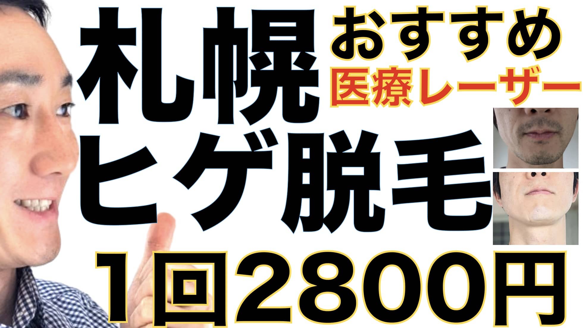1回2800円で医療ヤグレーザー！札幌でヒゲ脱毛なら湘南美容クリニックがおすすめな３つの理由サムネイル画像
