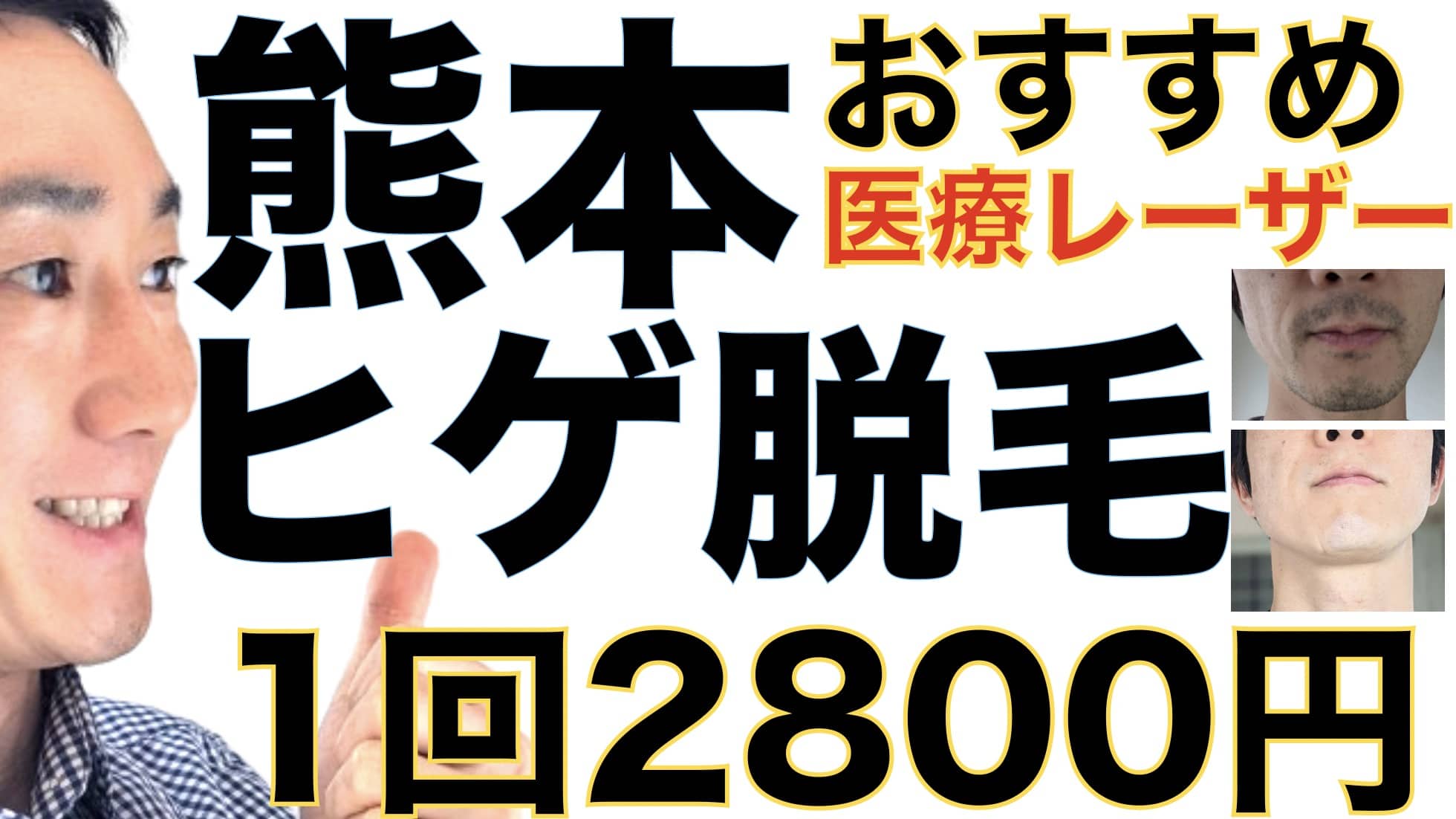 1回2800円で医療ヤグレーザー！熊本でヒゲ脱毛なら湘南美容クリニックがおすすめな３つの理由サムネイル画像