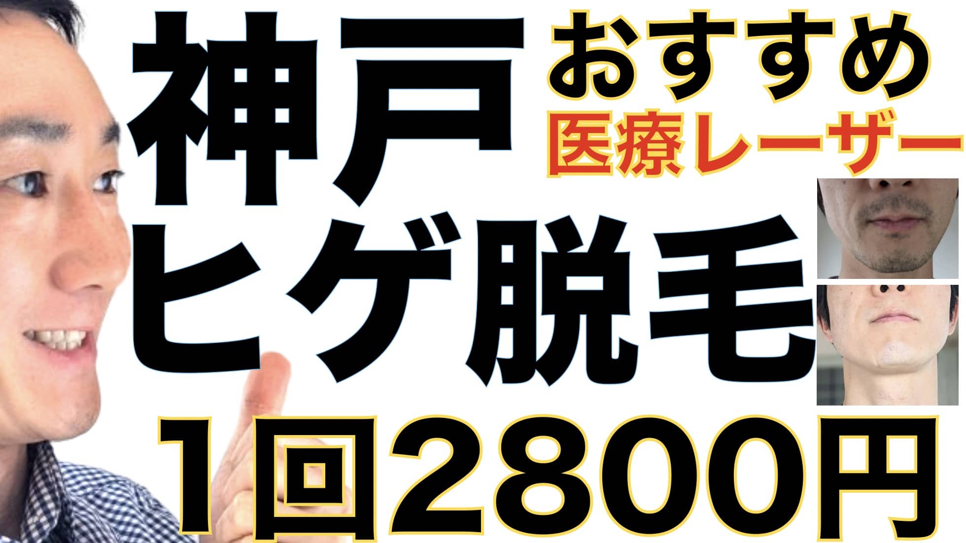 1回2800円で医療ヤグレーザー！神戸のヒゲ脱毛は湘南美容クリニックがおすすめな３つの理由サムネイル画像