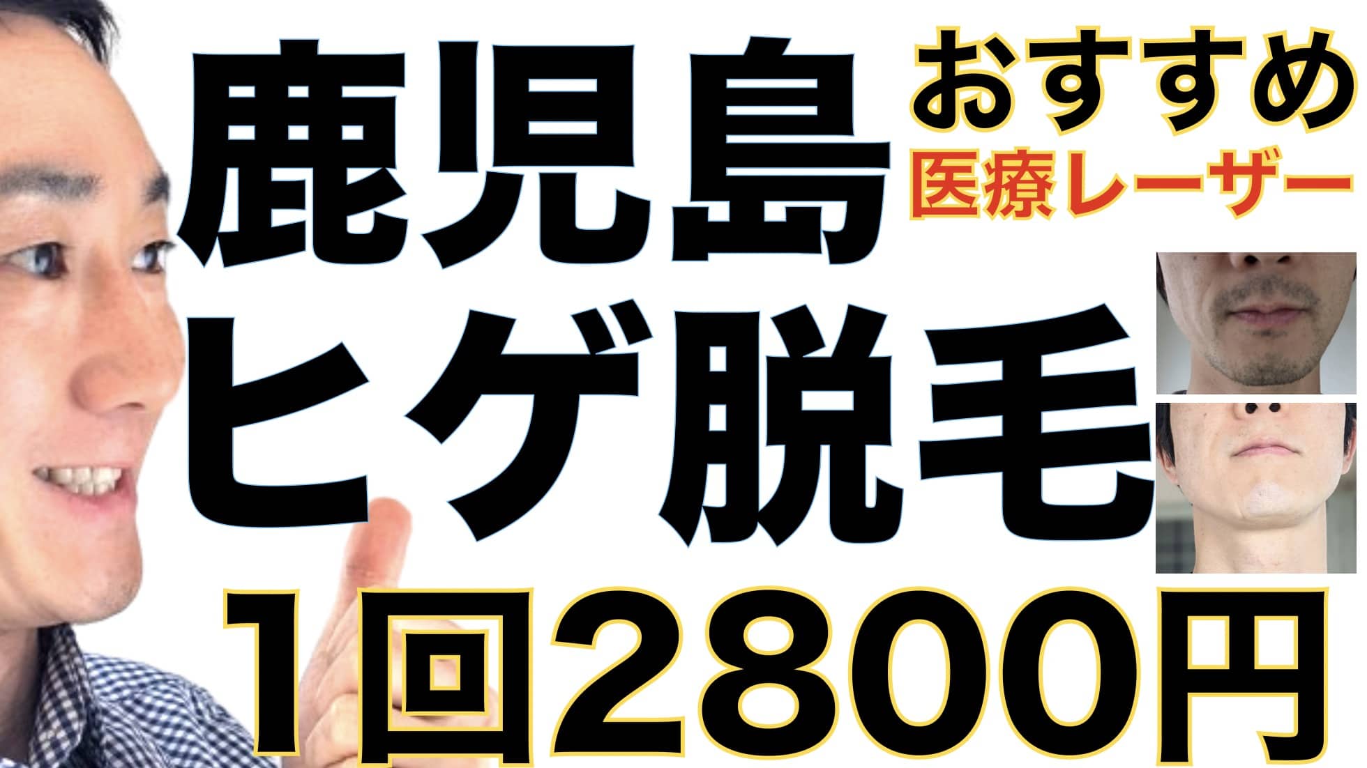 1回2800円で医療ヤグレーザー！鹿児島でヒゲ脱毛なら湘南美容クリニックがおすすめな３つの理由サムネイル画像