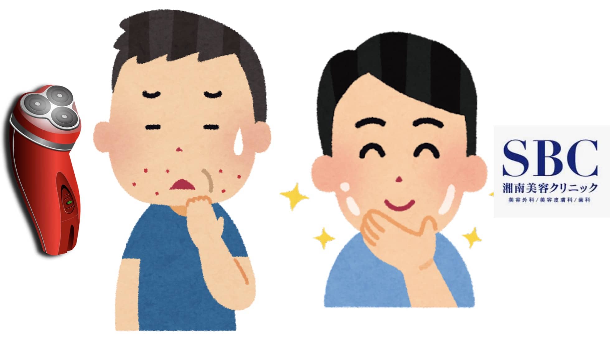 ひげ剃りで剃刀負けしていた男性がヒゲ脱毛でツルツルになった様子のイラスト