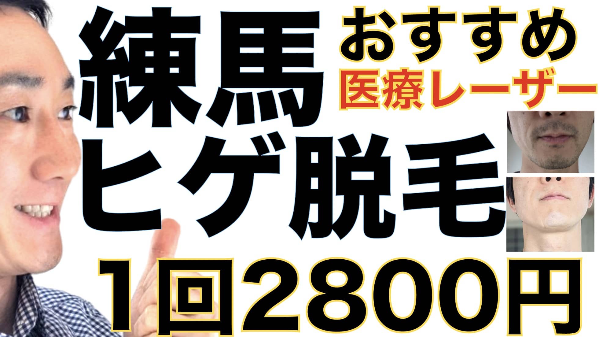元練馬住人が語る！ヒゲ脱毛は湘南美容クリニックがおすすめな３つの理由【1回2800円で医療ヤグレーザー】サムネイル画像