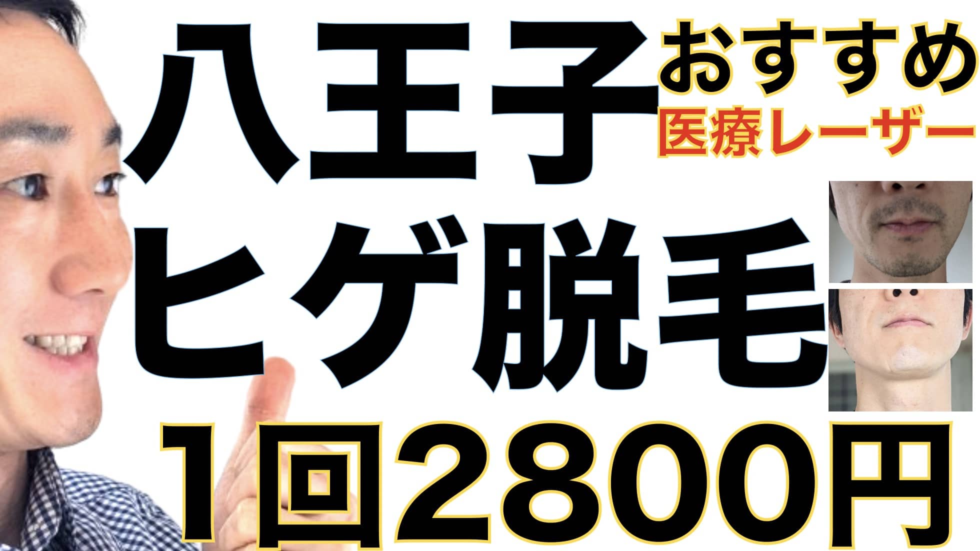 八王子のヒゲ脱毛は湘南美容クリニックがおすすめな３つの理由【1回2800円で医療ヤグレーザー】サムネイル画像