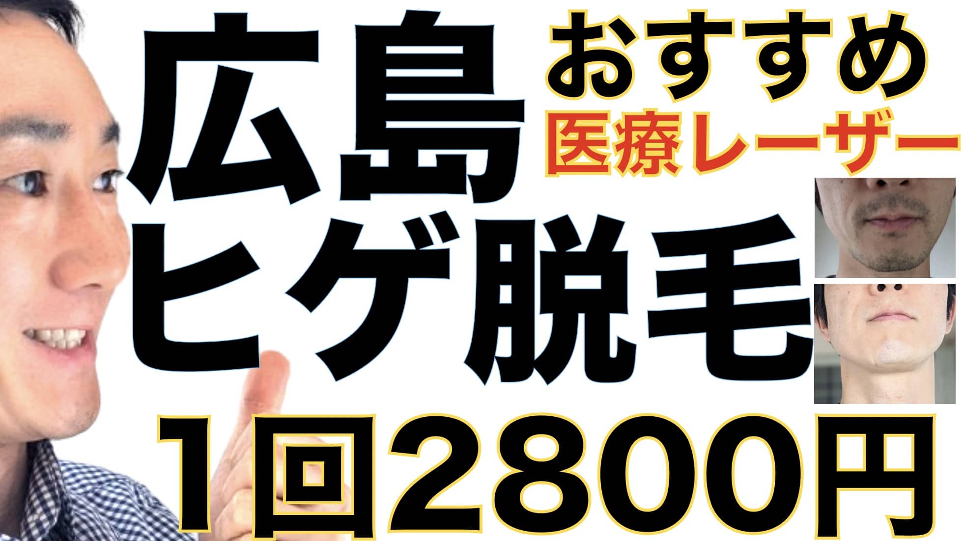 広島のヒゲ脱毛は湘南美容クリニックがおすすめな３つの理由【1回2800円で医療ヤグレーザー】サムネイル画像