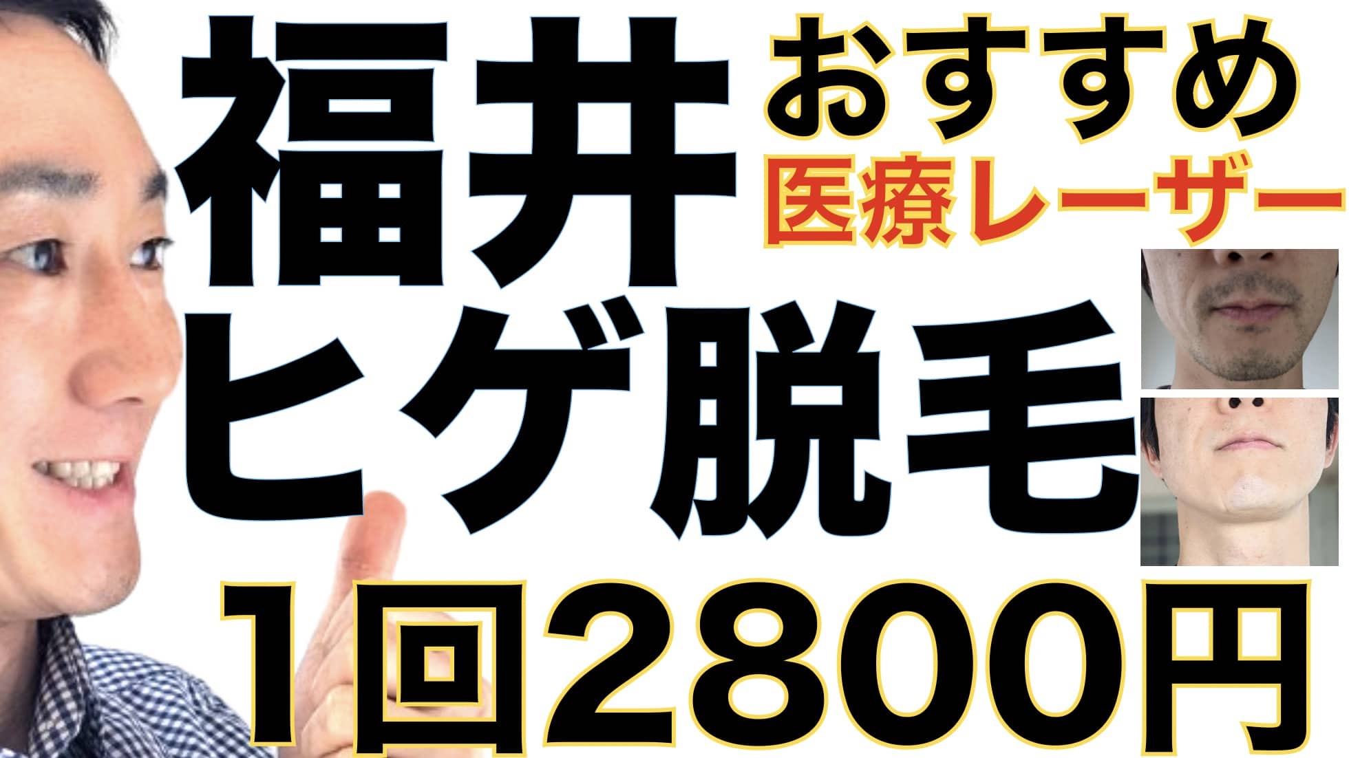 福井のヒゲ脱毛は湘南美容クリニックがおすすめな３つの理由【1回2800円で医療ヤグレーザー】サムネイル画像